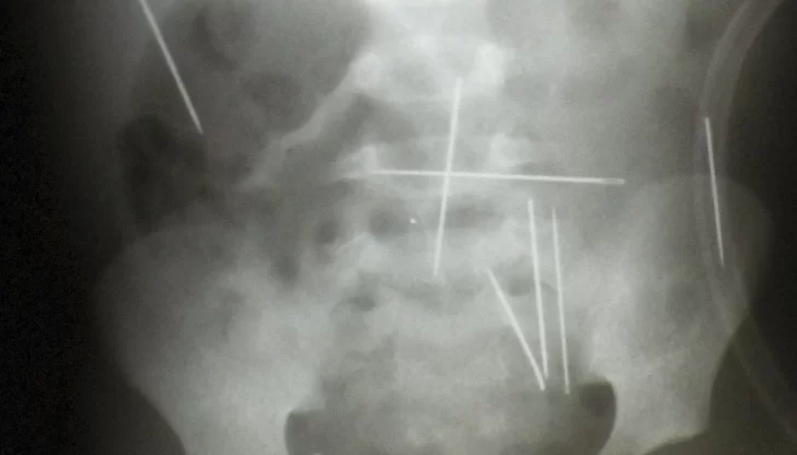 Le clavaron 50 agujas a un niño de dos años en un ritual Le clavaron 50 agujas a un niño de dos años en un ritual