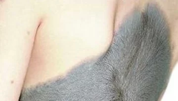 La “Niña gato” asombra a médicos del mundo La “Niña gato” asombra a médicos del mundo