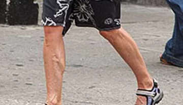 ¿Qué le pasó en las piernas? ¿Qué le pasó en las piernas?