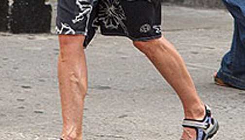 ¿Qué le pasó en las piernas? ¿Qué le pasó en las piernas?