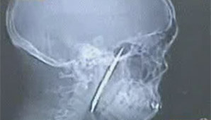 ¿Un cuchillo en la cabeza? ¿Un cuchillo en la cabeza?