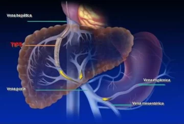 Cirugía hepática Cirugía hepática