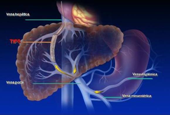 Cirugía hepática Cirugía hepática
