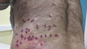 Por tener sobrepeso, un hombre sobrevivió a 38 puñaladas Por tener sobrepeso, un hombre sobrevivió a 38 puñaladas