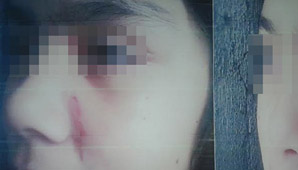 Denuncian caso de violencia escolar: rasguñaron brutalmente el rostro a menor de 12 años Denuncian caso de violencia escolar: rasguñaron brutalmente el rostro a menor de 12 años
