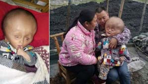 Hidrocefalia extrema Hidrocefalia extrema