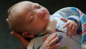 Nació un “bebé milagro” en EEUU: no tiene nariz Nació un “bebé milagro” en EEUU: no tiene nariz