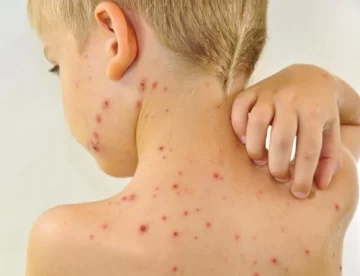 Niño de 9 años murió afectado por varicela Niño de 9 años murió afectado por varicela