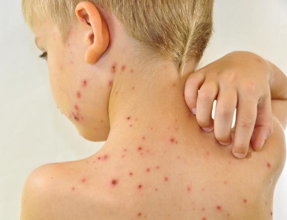 Niño de 9 años murió afectado por varicela Niño de 9 años murió afectado por varicela