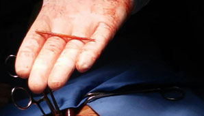 Le extrajeron del corazón un palillo que tragó un una picada Le extrajeron del corazón un palillo que tragó un una picada