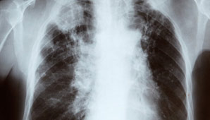 OMS: las 116 causas del cáncer OMS: las 116 causas del cáncer