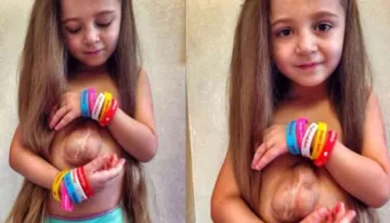 Impactante historia de la niña que nació con el corazón afuera del pecho que conmueve al mundo Impactante historia de la niña que nació con el corazón afuera del pecho que conmueve al mundo