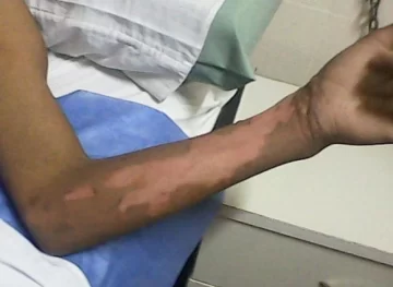 El drama de los chicos quemados: morfina las 24 hs y anestesia total para bañarlos El drama de los chicos quemados: morfina las 24 hs y anestesia total para bañarlos