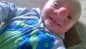 “Pinocho”, el nene al que le crece el cerebro en la nariz “Pinocho”, el nene al que le crece el cerebro en la nariz