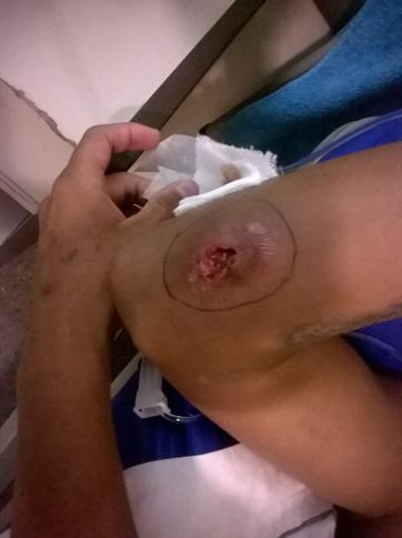 Dice que le picó un mosquito y ahora una larva le “come el nervio” Dice que le picó un mosquito y ahora una larva le “come el nervio”