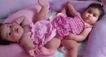 Murió una de las siamesas separadas Murió una de las siamesas separadas