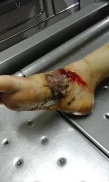 Fue a la casa de una compañerita y un pitbull casi le arranca un pie Fue a la casa de una compañerita y un pitbull casi le arranca un pie