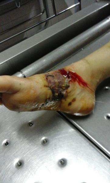 Fue a la casa de una compañerita y un pitbull casi le arranca un pie Fue a la casa de una compañerita y un pitbull casi le arranca un pie