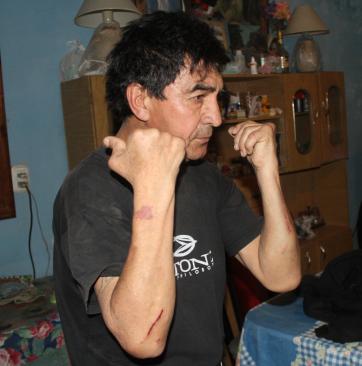 Una enfermedad deforma sus huesos y sufrió violento robo Una enfermedad deforma sus huesos y sufrió violento robo