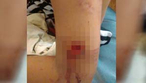 Un dogo le destrozó el brazo a un niño que festejaba un cumpleaños Un dogo le destrozó el brazo a un niño que festejaba un cumpleaños