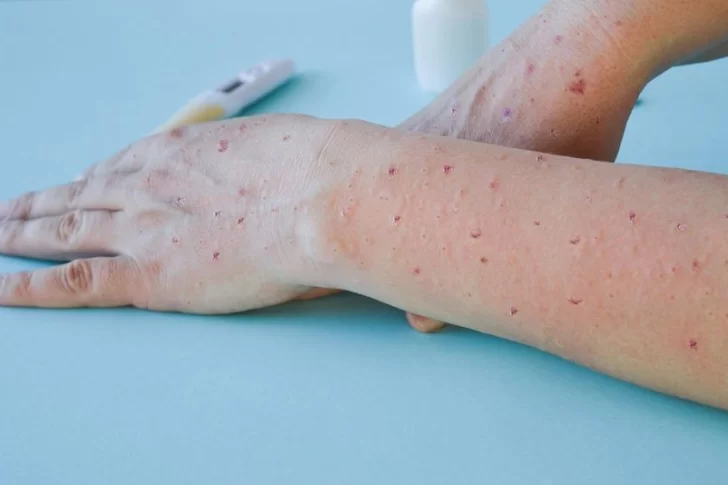 Confirmaron la segunda muerte por viruela del mono en Argentina