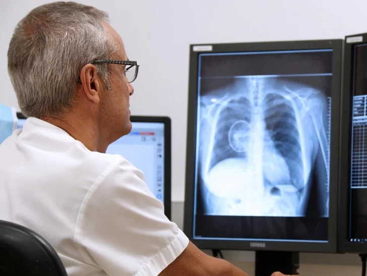 Neumonólogos argentinos impulsan proyecto para mejorar el diagnóstico temprano de cáncer de pulmón Neumonólogos argentinos impulsan proyecto para mejorar el diagnóstico temprano de cáncer de pulmón