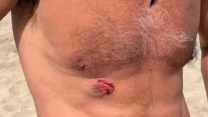 Denunció que fue mordido por un vendedor ambulante y tuvo un final inesperado Denunció que fue mordido por un vendedor ambulante y tuvo un final inesperado