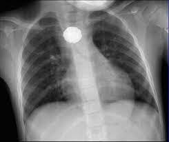 Un nene de 5 años se tragó una pila, la tuvo atascada un mes y no se murió de milagro Un nene de 5 años se tragó una pila, la tuvo atascada un mes y no se murió de milagro