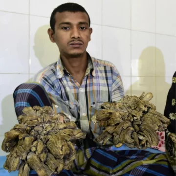 El “hombre árbol”, al borde de la muerte El “hombre árbol”, al borde de la muerte