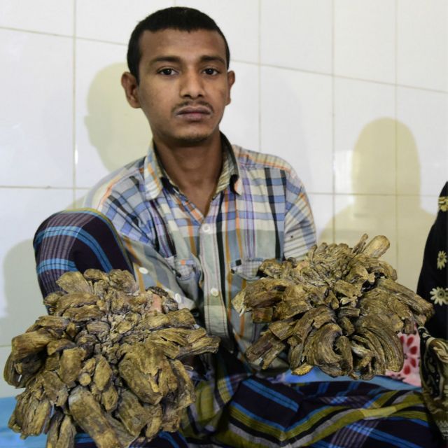 El “hombre árbol”, al borde de la muerte El “hombre árbol”, al borde de la muerte