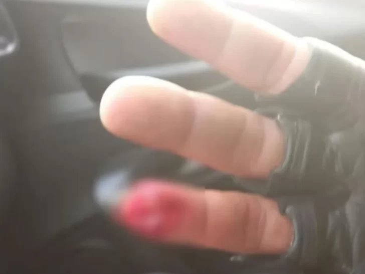 Mordió a un policía y se tragó parte de su dedo Mordió a un policía y se tragó parte de su dedo