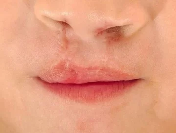 Cuál es el componente clave del labio leporino y cuáles son las causas Cuál es el componente clave del labio leporino y cuáles son las causas