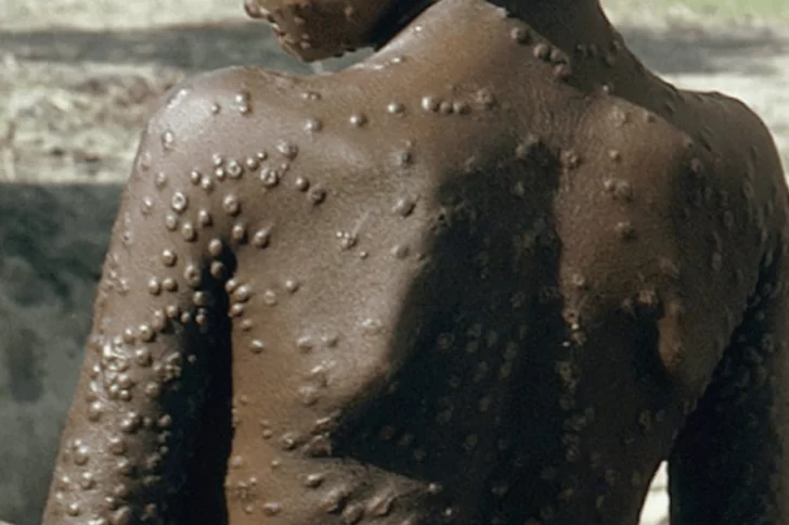 Crece el alerta mundial por avance de viruela del mono Crece el alerta mundial por avance de viruela del mono