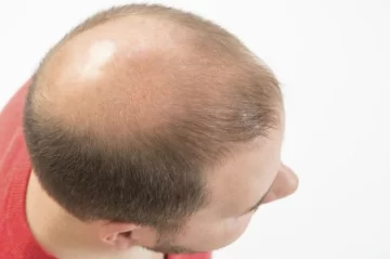 Un shampoo en base a jarilla es la nueva esperanza contra la calvicie Un shampoo en base a jarilla es la nueva esperanza contra la calvicie