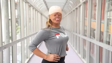 La historia de Brisa: se quemó el 88% del cuerpo cuando era bebé y hoy es modelo La historia de Brisa: se quemó el 88% del cuerpo cuando era bebé y hoy es modelo