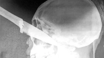 Cuatro chicas le clavaron un cuchillo en el ojo a otra Cuatro chicas le clavaron un cuchillo en el ojo a otra