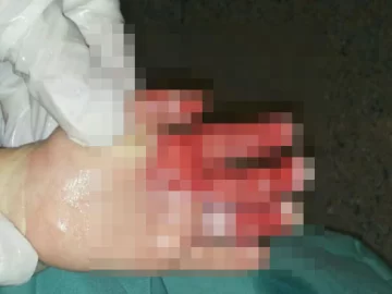 Una nena de 3 años recibió una descarga eléctrica y terminó con una mano quemada Una nena de 3 años recibió una descarga eléctrica y terminó con una mano quemada