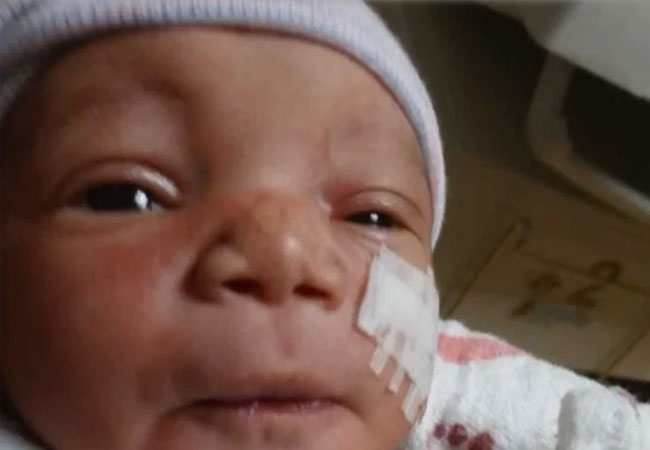 Le cortaron la cara a una beba recién nacida en una cesárea: le hicieron 13 puntos Le cortaron la cara a una beba recién nacida en una cesárea: le hicieron 13 puntos