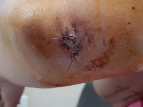 Se accidentó, dice que la curaron mal en el Rawson y tuvo que operarse por una infección Se accidentó, dice que la curaron mal en el Rawson y tuvo que operarse por una infección