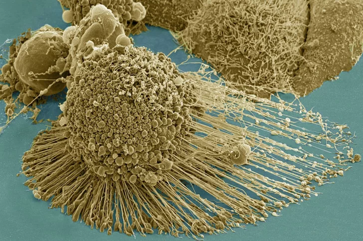 Un análisis de sangre experimental alerta del cáncer cuatro años antes