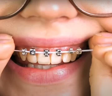 Odontólogos piden que los jóvenes no se sumen a la moda de los brackets falsos Odontólogos piden que los jóvenes no se sumen a la moda de los brackets falsos