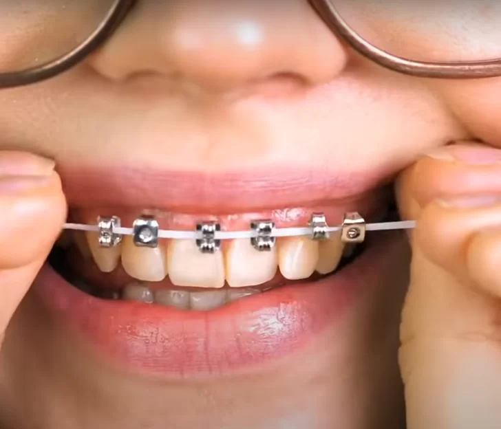 Odontólogos piden que los jóvenes no se sumen a la moda de los brackets falsos