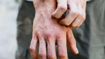 De qué se trata el síndrome de “dedos congelados”, nuevo síntoma del coronavirus De qué se trata el síndrome de “dedos congelados”, nuevo síntoma del coronavirus