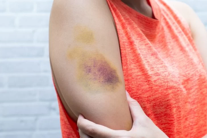 ¿Cómo tratar moretones?