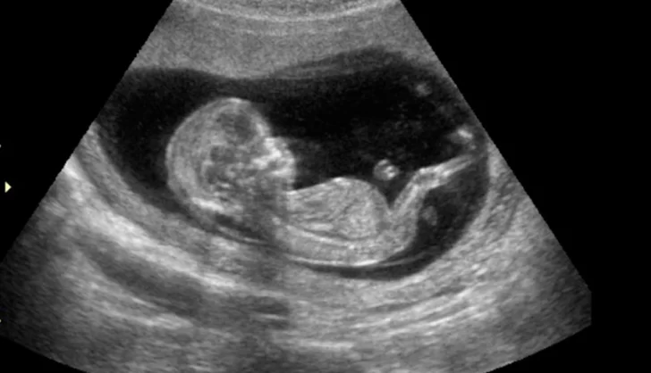 Se hizo una ecografía para ver a su bebé y apareció algo extraño Se hizo una ecografía para ver a su bebé y apareció algo extraño