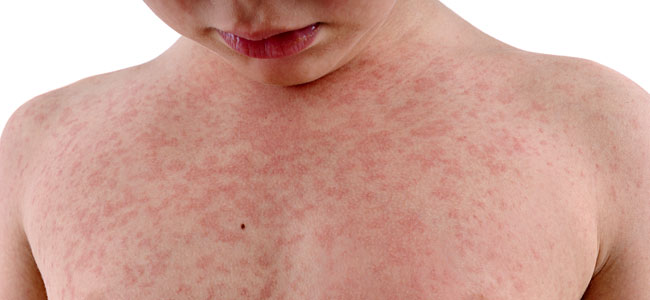 Alarma en una escuela de Iglesia por 30 casos de escarlatina y varicela Alarma en una escuela de Iglesia por 30 casos de escarlatina y varicela