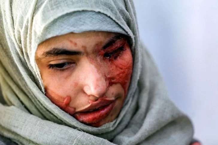 Niña obligada a casarse a los 12 fue desfigurada con ácido por su marido