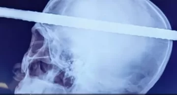IMAGEN MUY FUERTE: una barra de hierro le atravesó la cabeza y de milagro sobrevivió IMAGEN MUY FUERTE: una barra de hierro le atravesó la cabeza y de milagro sobrevivió