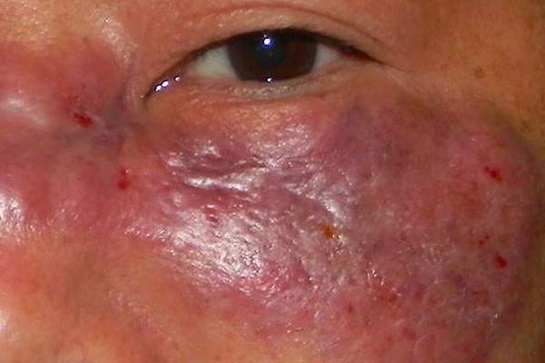 Alerta por caso de “hongo negro” que registró Formosa Alerta por caso de “hongo negro” que registró Formosa