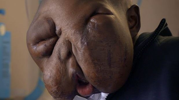 La increíble trasformación de un joven al que extirparon un tumor de la cara La increíble trasformación de un joven al que extirparon un tumor de la cara